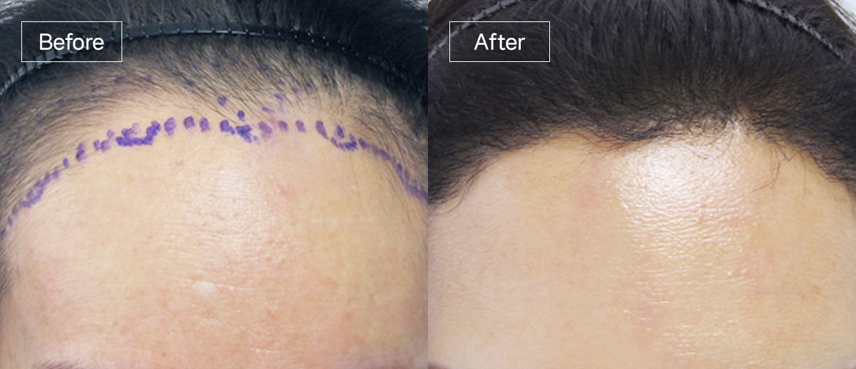 /filedata/md_board/20260102172747_giAFClB4_sub3_slide6.jpg 전후사진