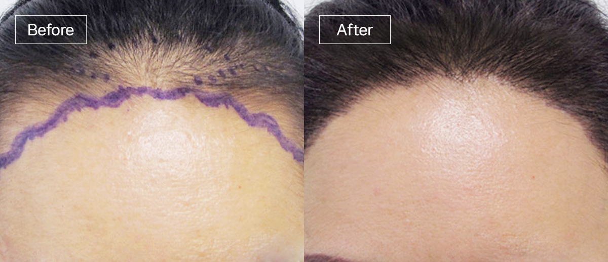 /filedata/md_board/20260102172756_yfRG2WOz_sub3_slide5.jpg 전후사진