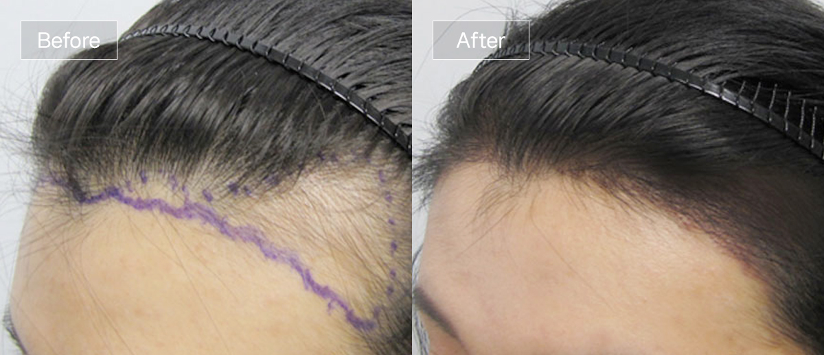 /filedata/md_board/20260102172805_5Nid2aIZ_sub3_slide4.jpg 전후사진