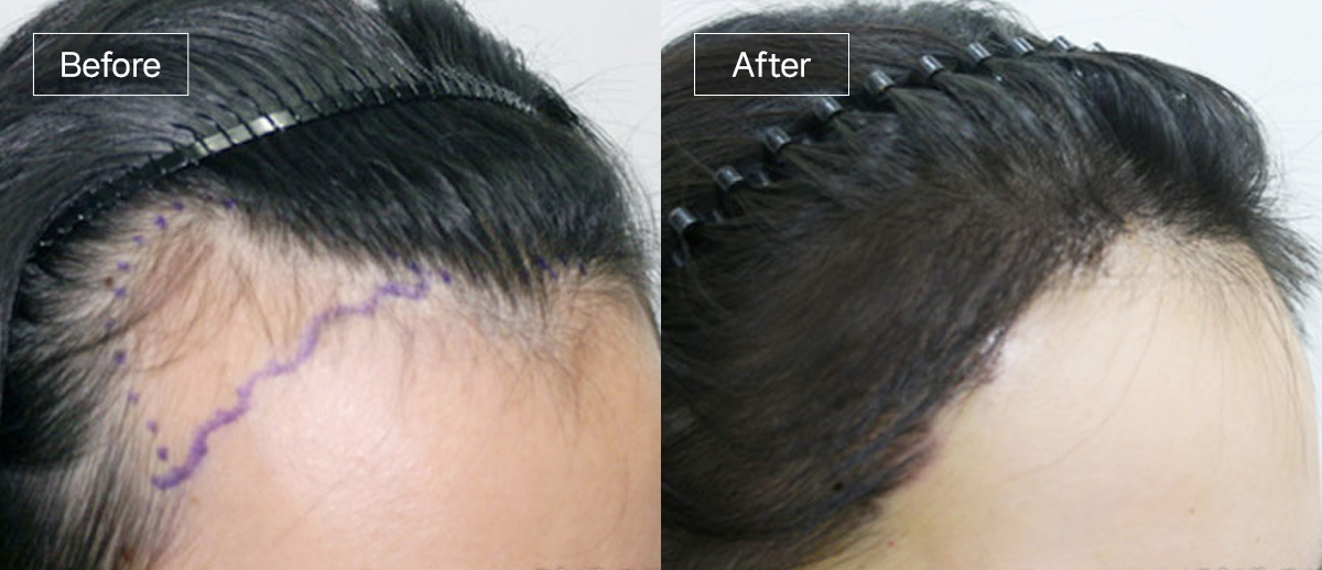 /filedata/md_board/20260102172827_EzXrlVf3_sub3_slide3.jpg 전후사진