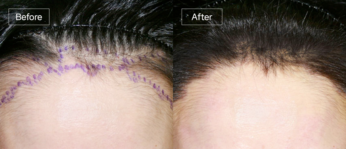 /filedata/md_board/20260102172837_PQiK2YEb_sub3_slide2.jpg 전후사진